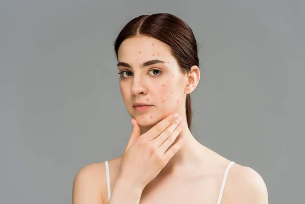 soins-anti-acne-the-ordinary-visage-type-peau-grasse