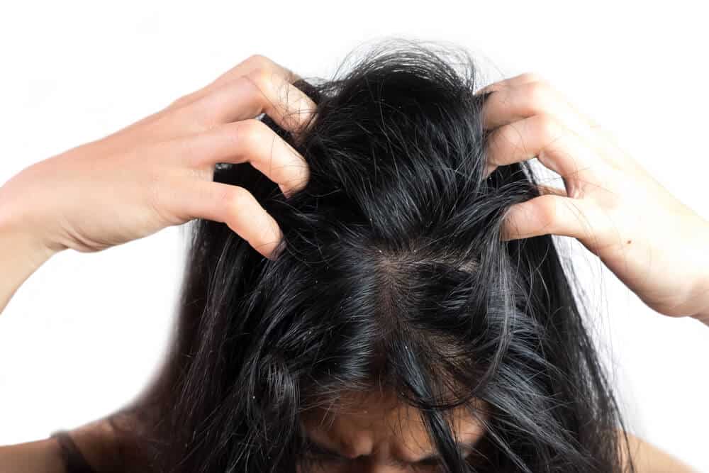 psoriasis cheveux astuces